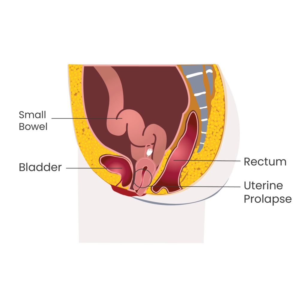 uterus prolapse