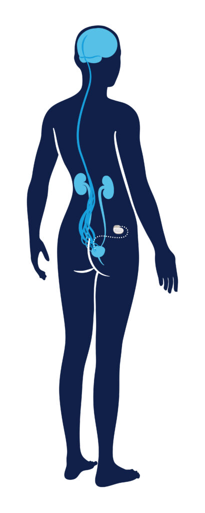 Sacral Nerve Stimulation Interstim™ Therapy Midwest Center For Pelvic Health 1146